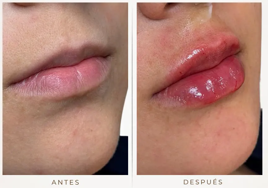 Antes y después: Diseño de labios