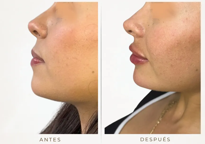 Antes y después: Armonización de perfil (labios, rinomodelación, mentón)