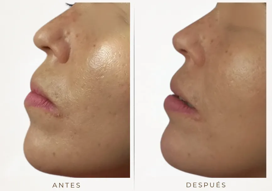 Antes y después: Rinomodelación y mentón