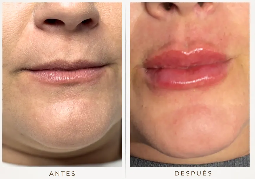 Antes y después: Diseño de labios