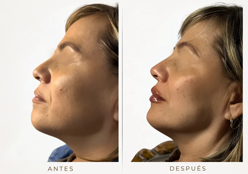 Antes y después: Armonización facial (labios, mentón, rinomodelación, pómulos)