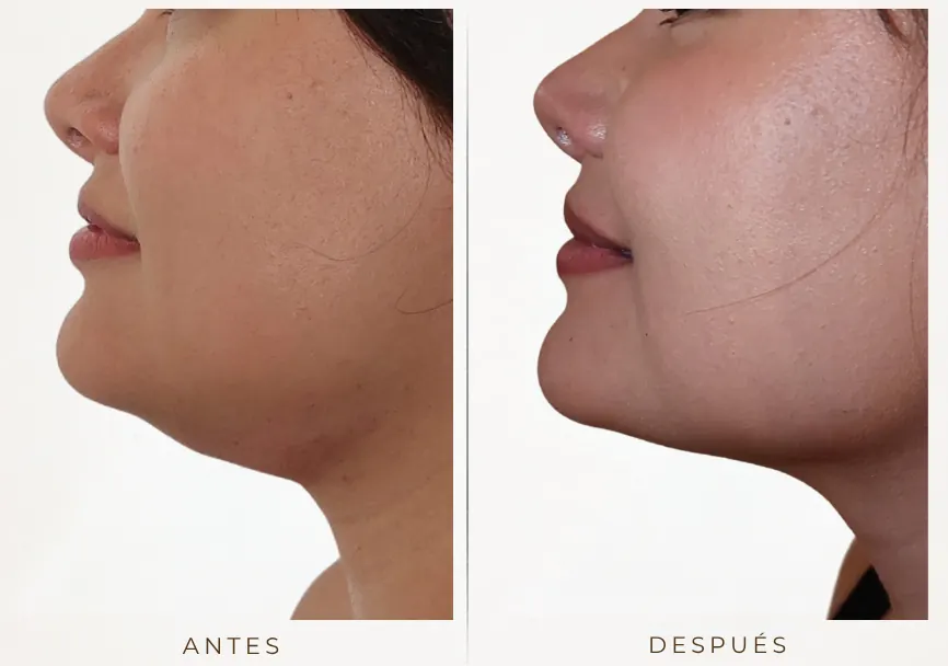 Antes y después: Lipopapada y bichectomía enzimática