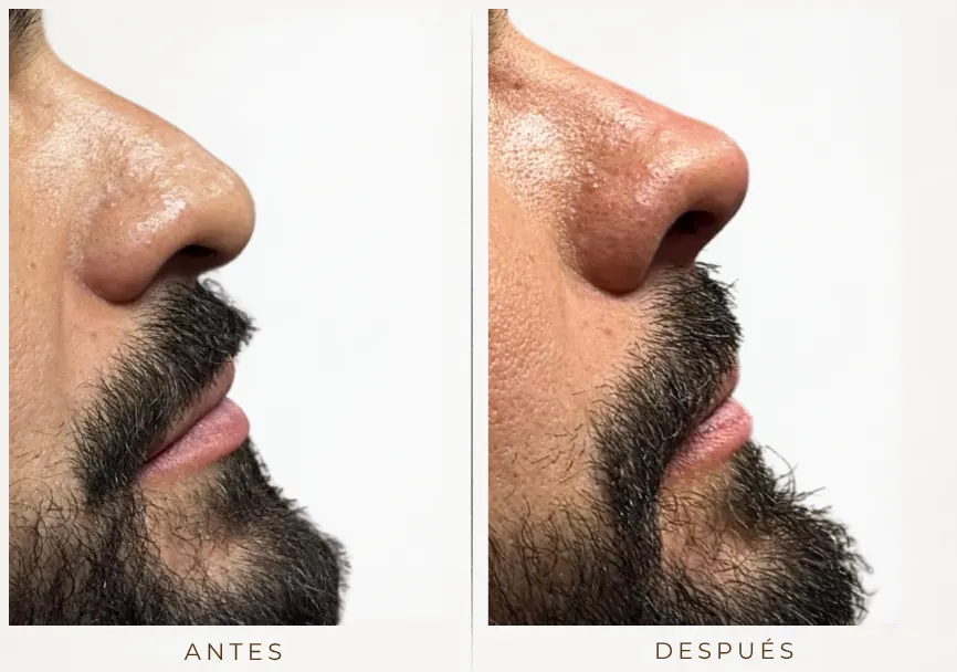 Antes y después: Rinomodelación