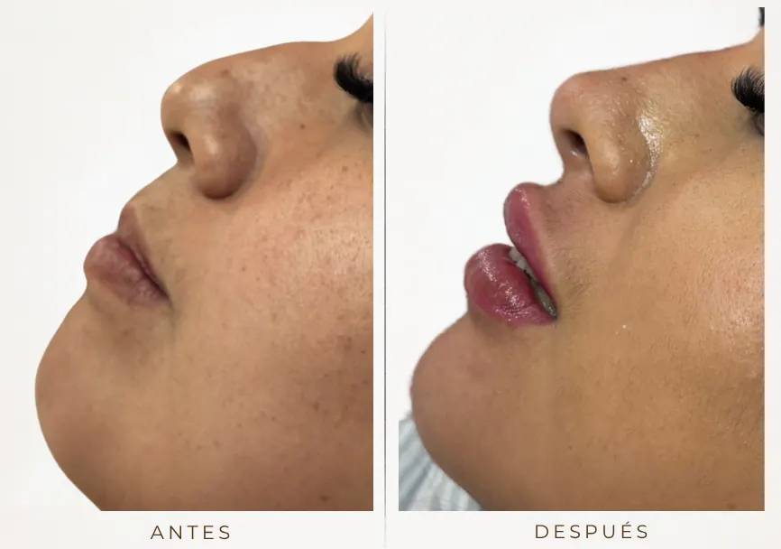 Antes y después: Armonización facial (rinomodelación, labios, mentón)